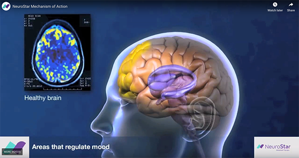 TMS Therapy is the Right Choice